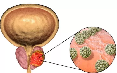 Prostate Cancer – What Does It Mean?