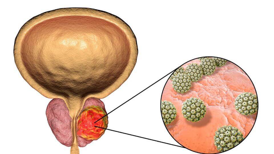 Prostate Cancer – What Does It Mean?